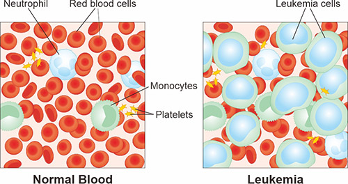 正常血液和白血病的成分示意圖
